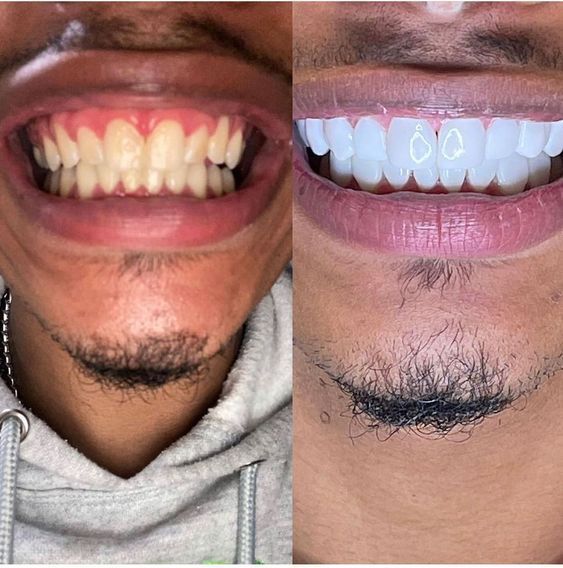 🦷 Purple Smile™ – Pasta Dental Violeta Blanqueadora Instantánea